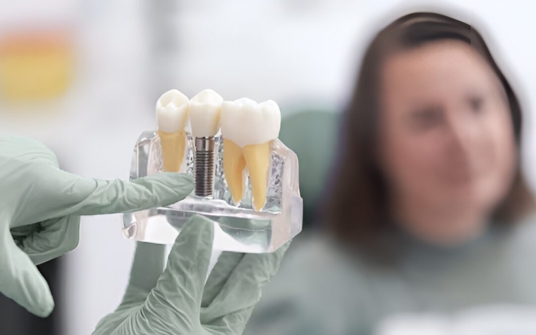 Ventajas de los implantes dentales