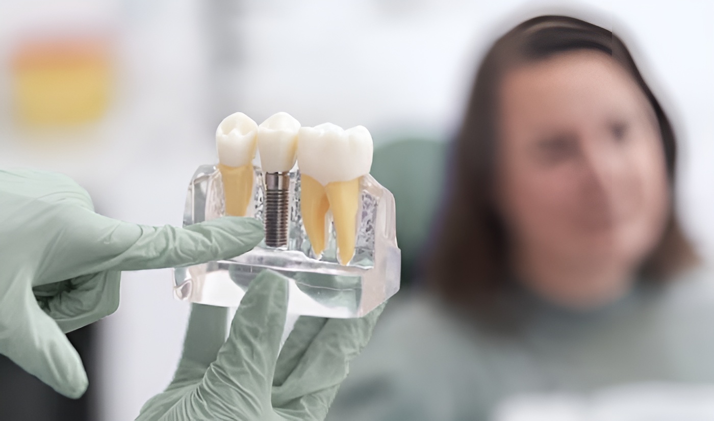 Ventajas de los implantes dentales