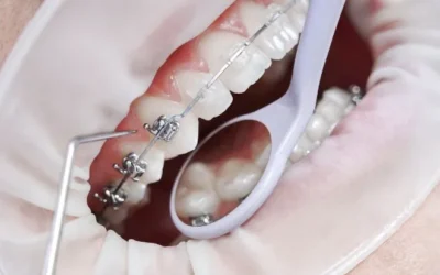 Ortodoncia en Madrid: mejora tu sonrisa y tu salud bucodental