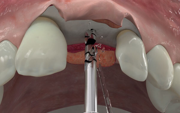Implantes dentales Madrid Implantes dentales Madrid