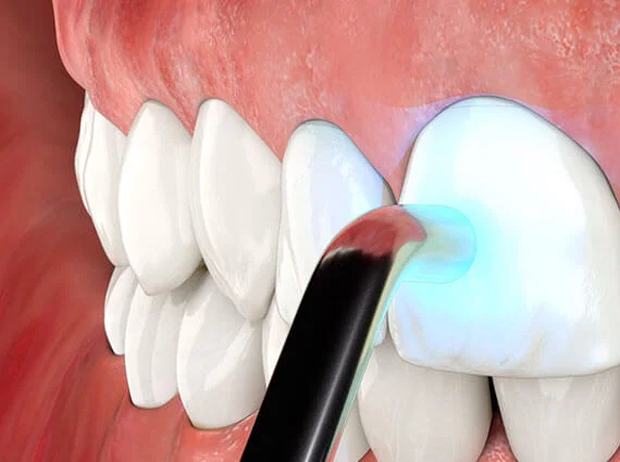 Coronas dentales Madrid