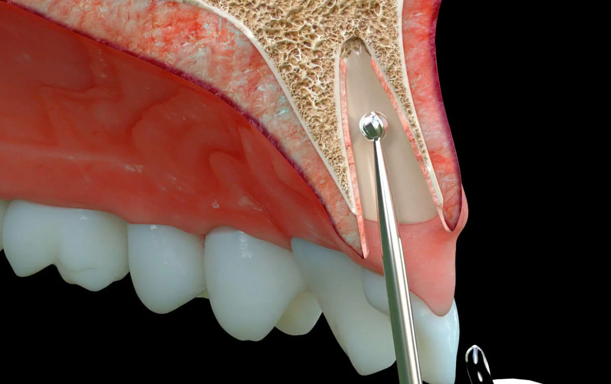 Implantes carga inmediata Madrid 
