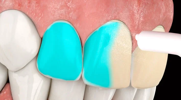 Diferentes tipos carillas dentales Madrid 