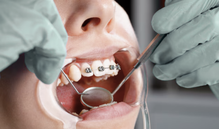 Elegir el mejor método de ortodoncia