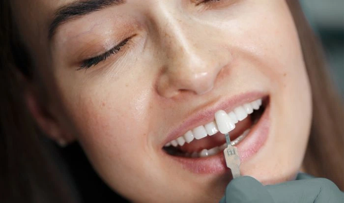 Qué son las carillas dentales