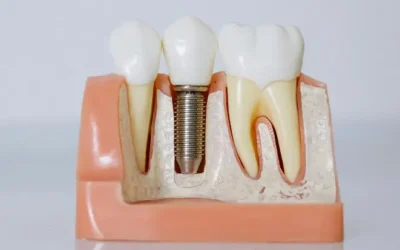 Errores tras colocarse un implante dental que pueden comprometer su éxito
