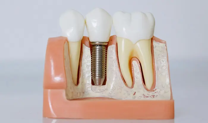 Implante dental Madrid